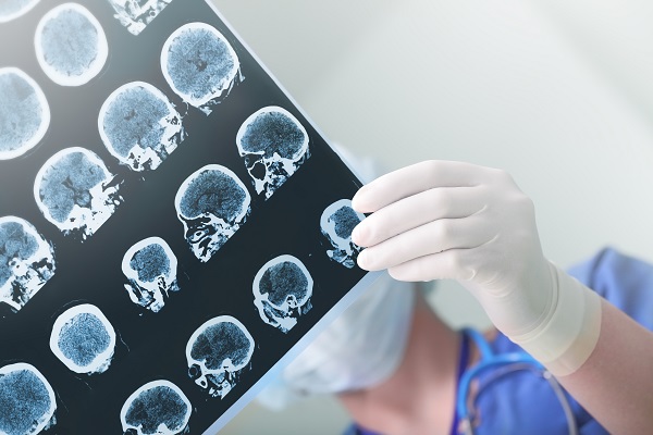 MEDICINA//Neurólogo entrega claves para reconocer y prevenir los accidentes cerebrovasculares