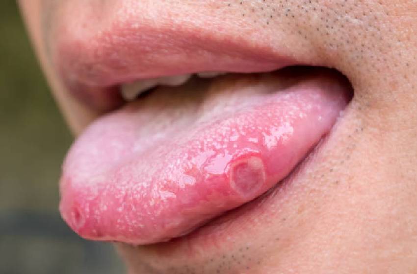 Escuela de Odontología conmemoró la Semana del Cáncer Oral con charlas sobre prevención