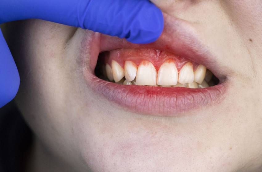 Científicos chilenos afirman que la periodontitis podría ser tan antigua como el origen de los mamíferos