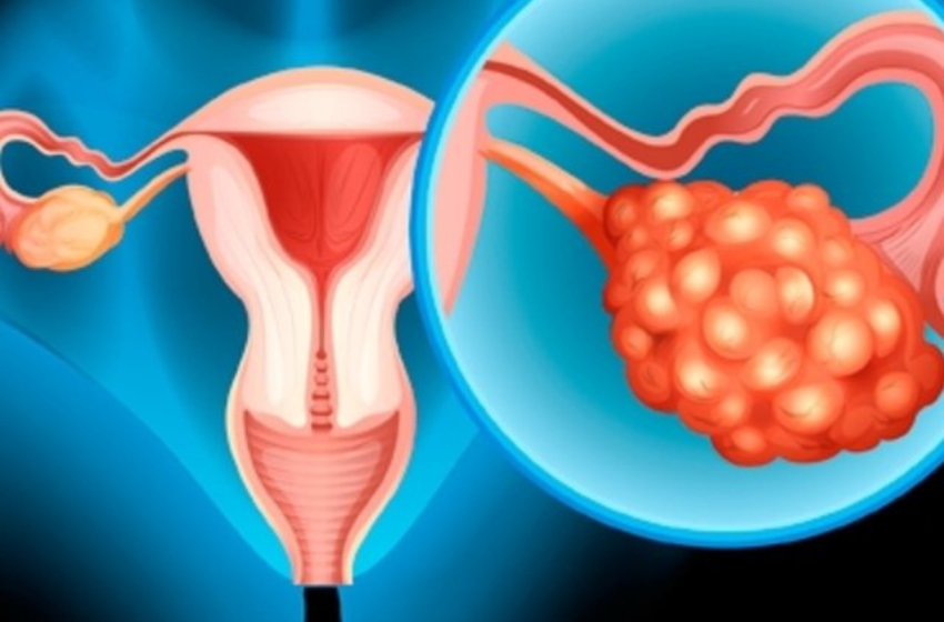 Cáncer de ovario: un mal silencioso